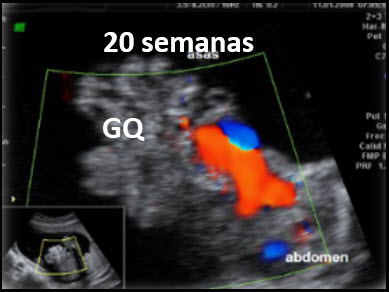 Ecografía prenatal de gastrosquisis a las 20 semanas mostrando intestino exteriorizado