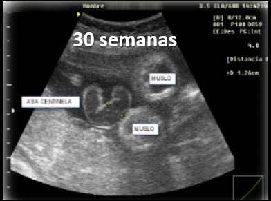 Ecografía prenatal de gastrosquisis a las 30 semanas con dilatación intestinal o asa centinela