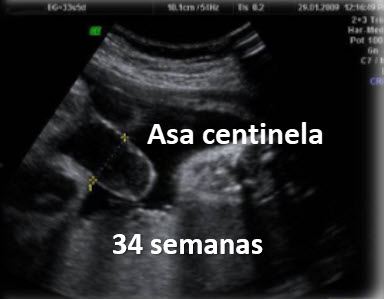 Ecografía prenatal de gastrosquisis a las 34 semanas mostrando dilatación progresiva del intestino
